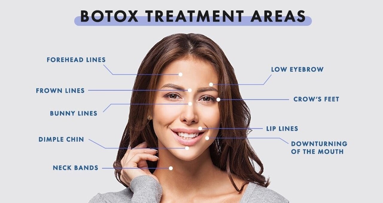botox treatment areas