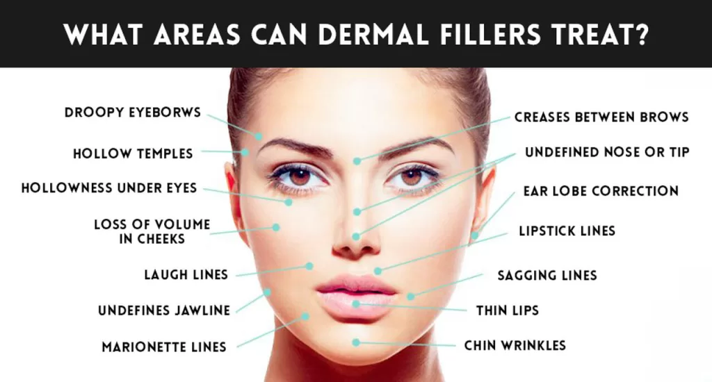 dermal fillers treatment areas