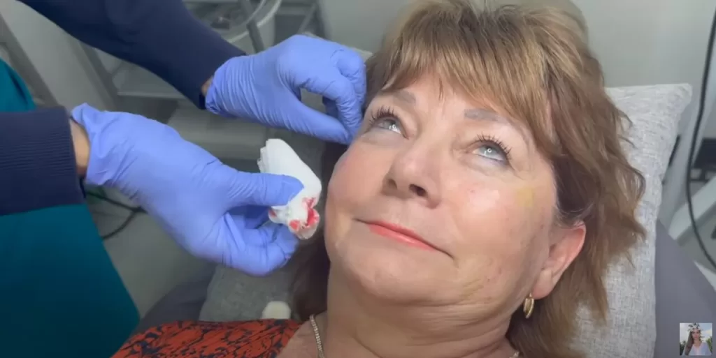What is a Thread Lift - Dr Donna Performs a Thread Lift