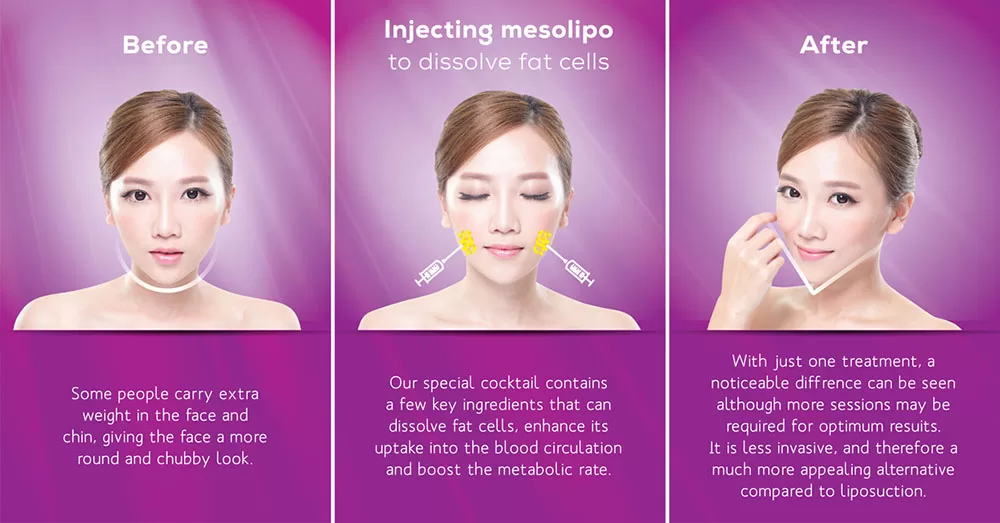 mesotherapy before and after