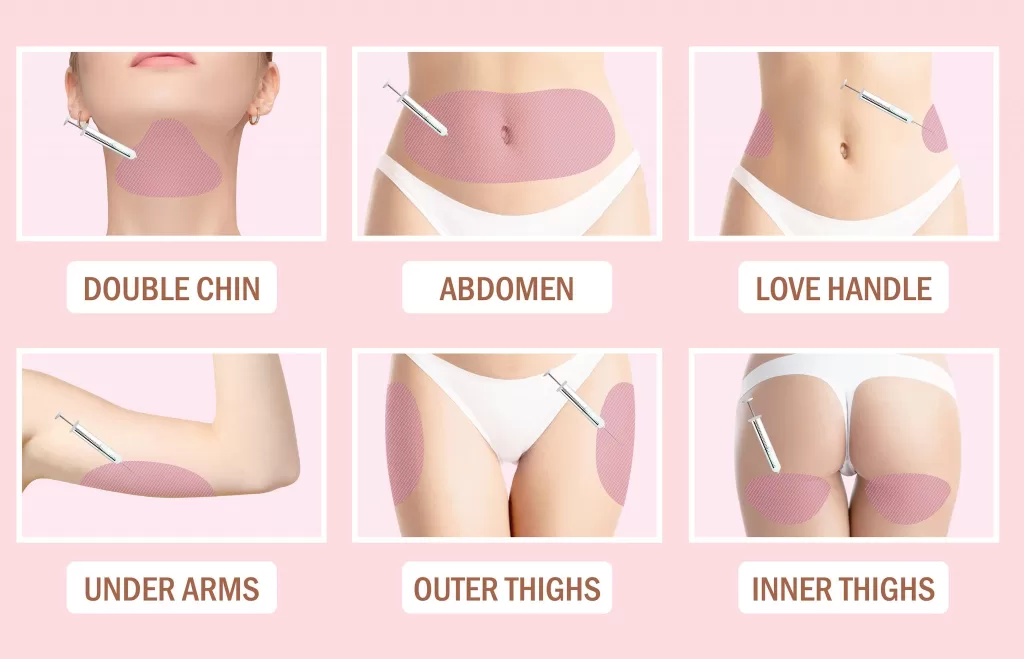 areas treated using mesotherapy