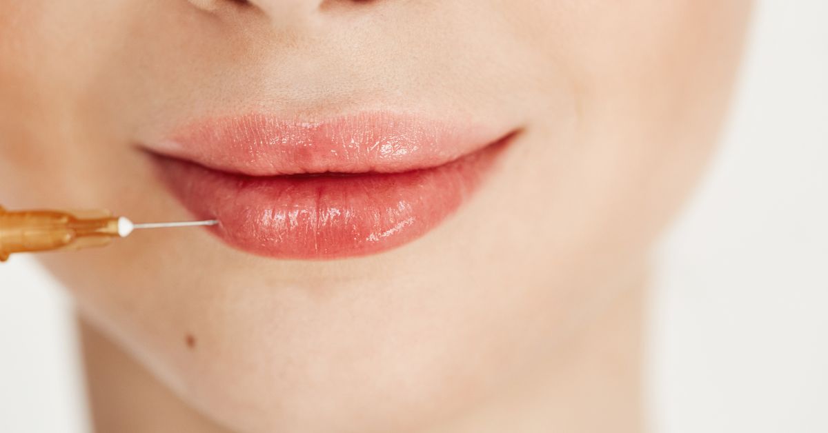 neuramis deep lip filler